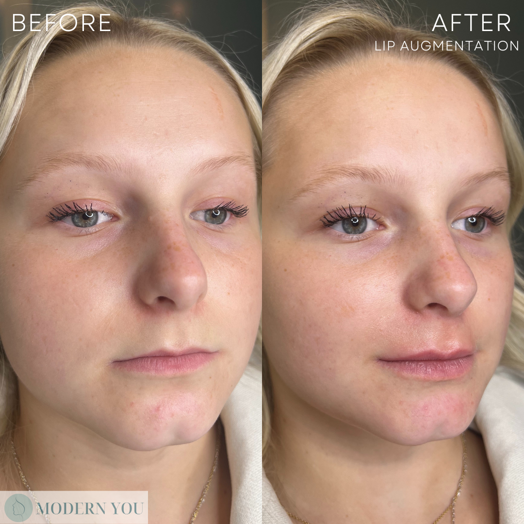 Side-by-side comparison of a woman's face: before and after lip augmentation, showing fuller lips and more defined facial features.