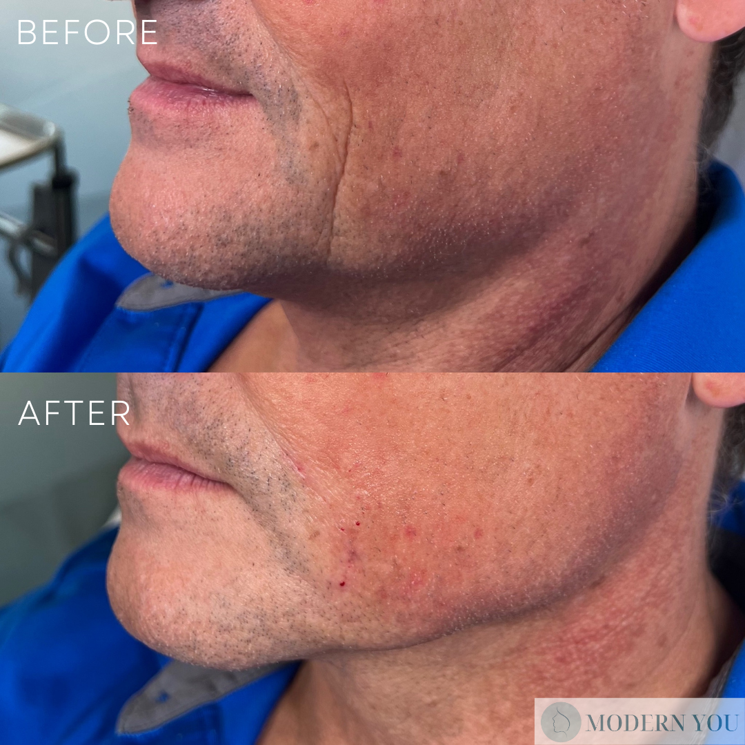 Side-by-side comparison: man's face before/after cosmetic treatment, showing reduced wrinkles.
