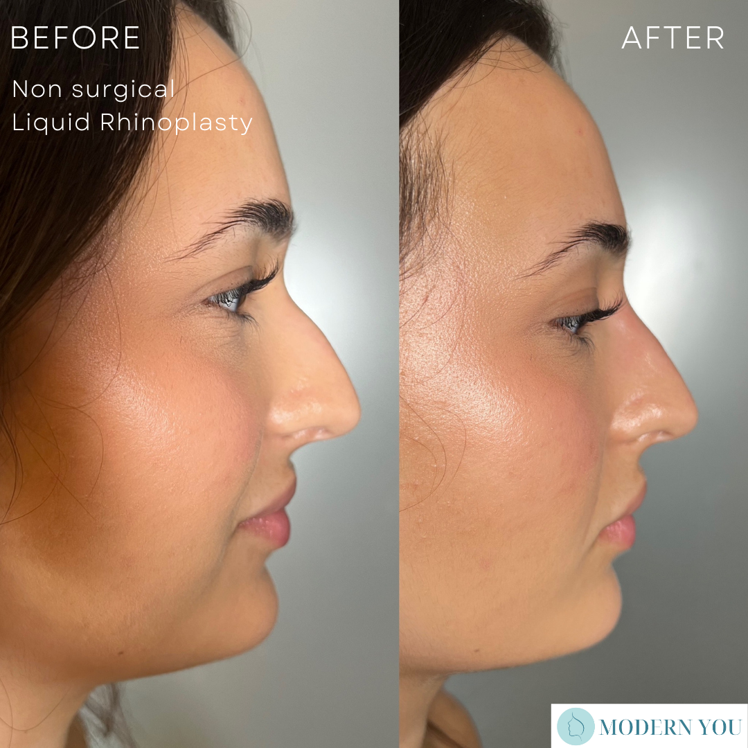 Side-by-side photos: Before & After liquid rhinoplasty. Woman's nose reshaped, tip and bridge altered.