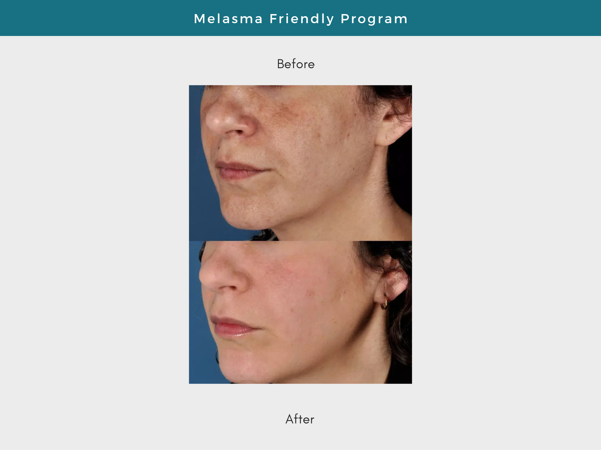 Comparison of a woman's face before and after treatment for melasma; skin discoloration significantly reduced.