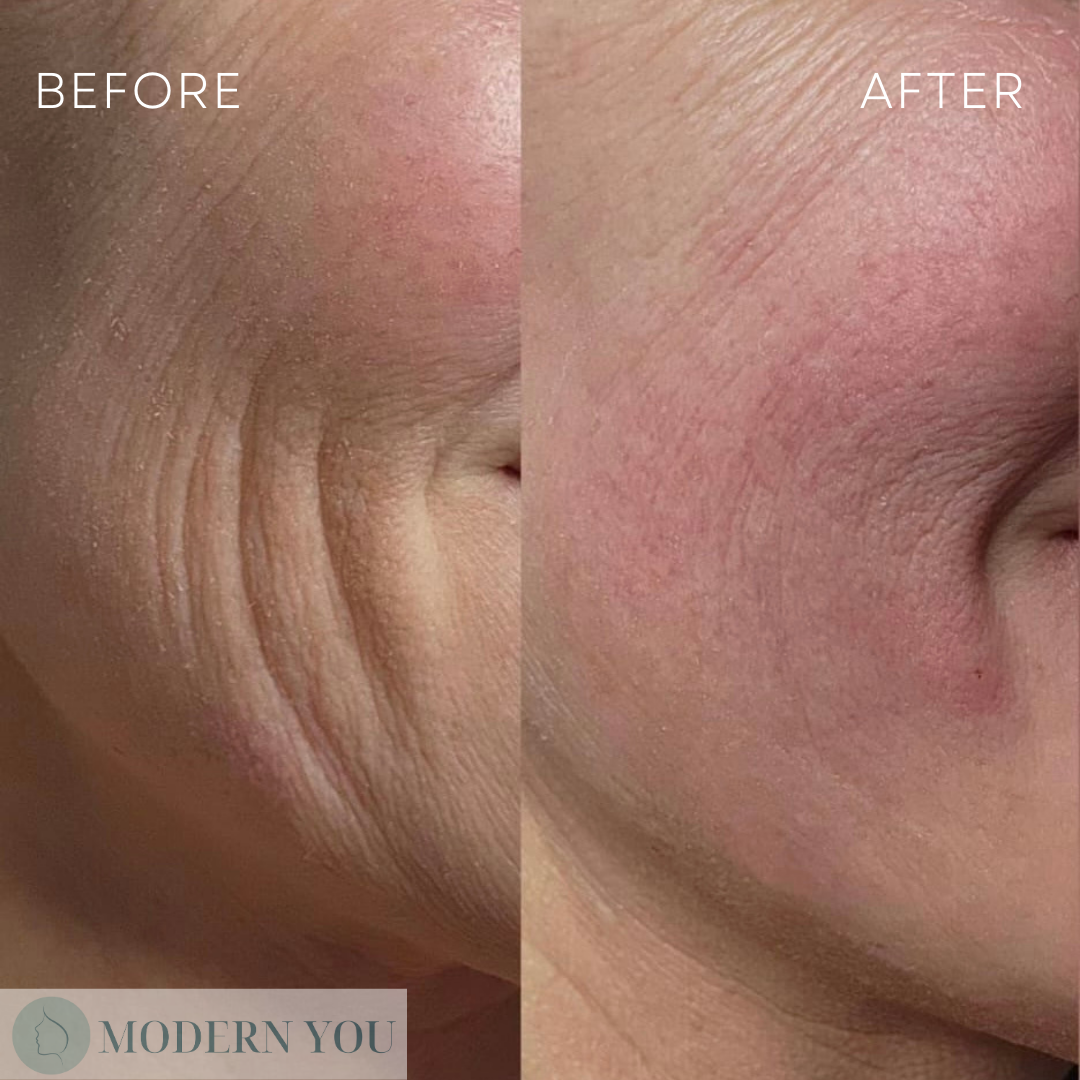 Wrinkled face before and smooth face after, side-by-side comparison of anti-aging treatment.
