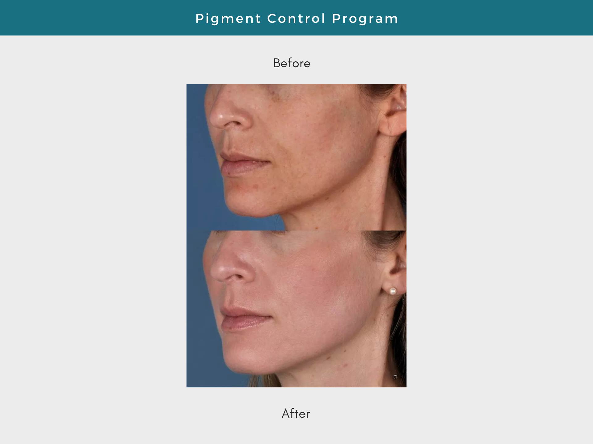 Before and after of a woman's face showing pigment control program results. Top image: uneven skin tone. Bottom image: improved skin tone.