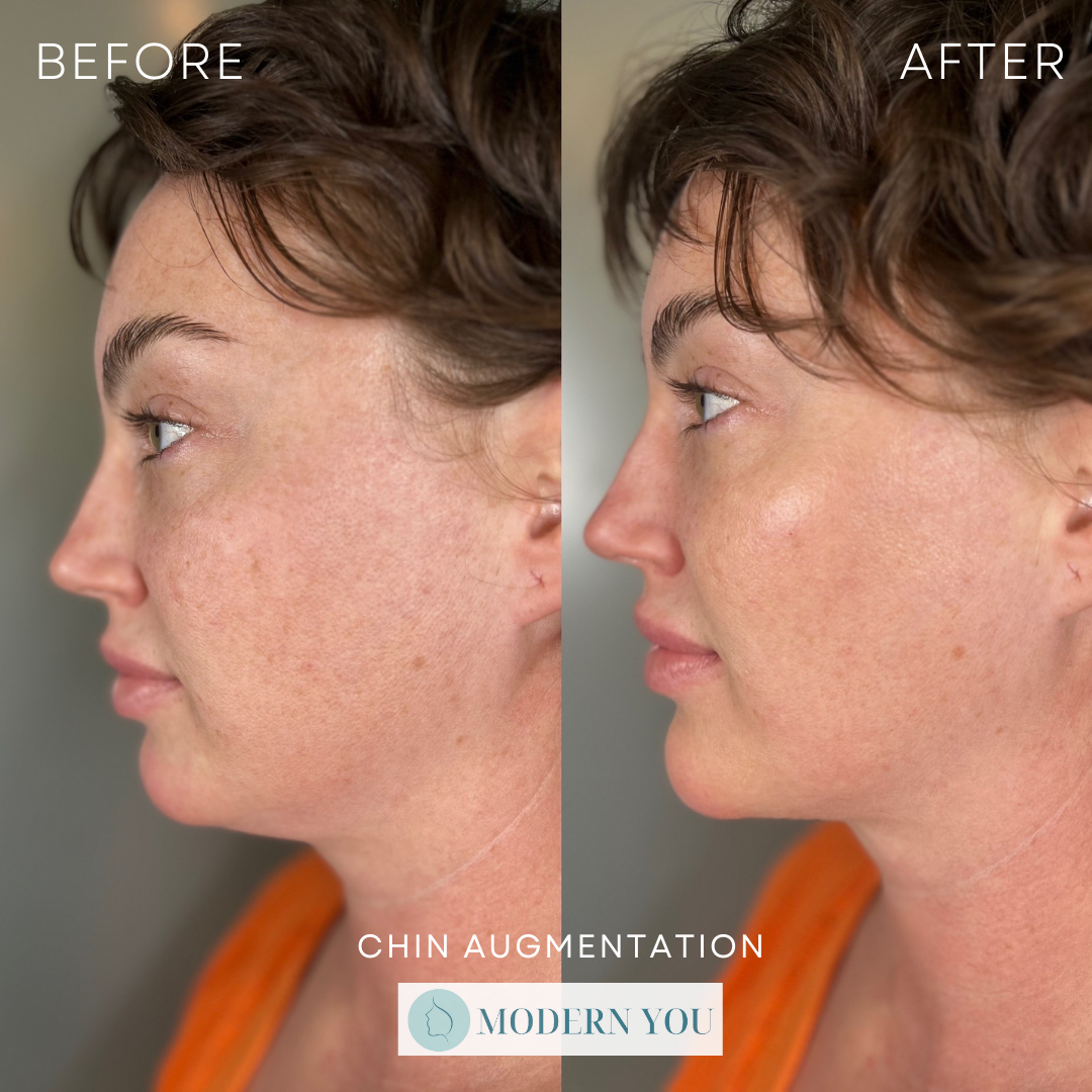 Side-by-side before and after photos of a woman's face showing the effects of chin augmentation. Skin is lighter after procedure.