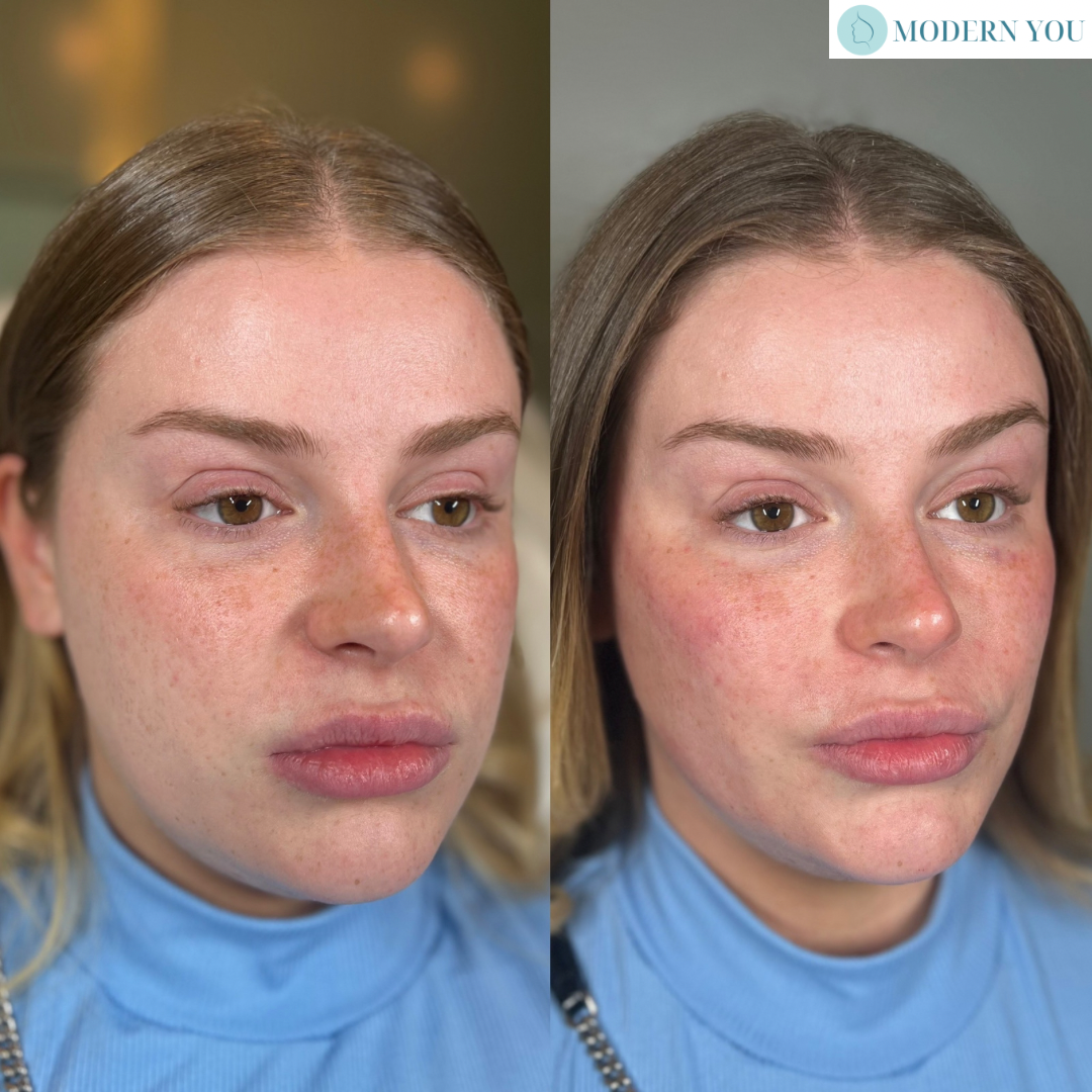 Before-and-after photos showing a woman's face; the second photo showing fuller lips and a slightly rosier complexion.