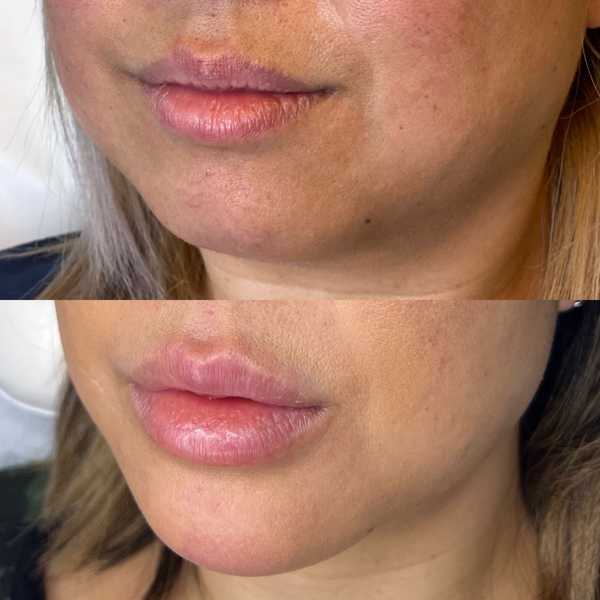 Before and after photos of woman's lips, with increased volume after lip filler injections.