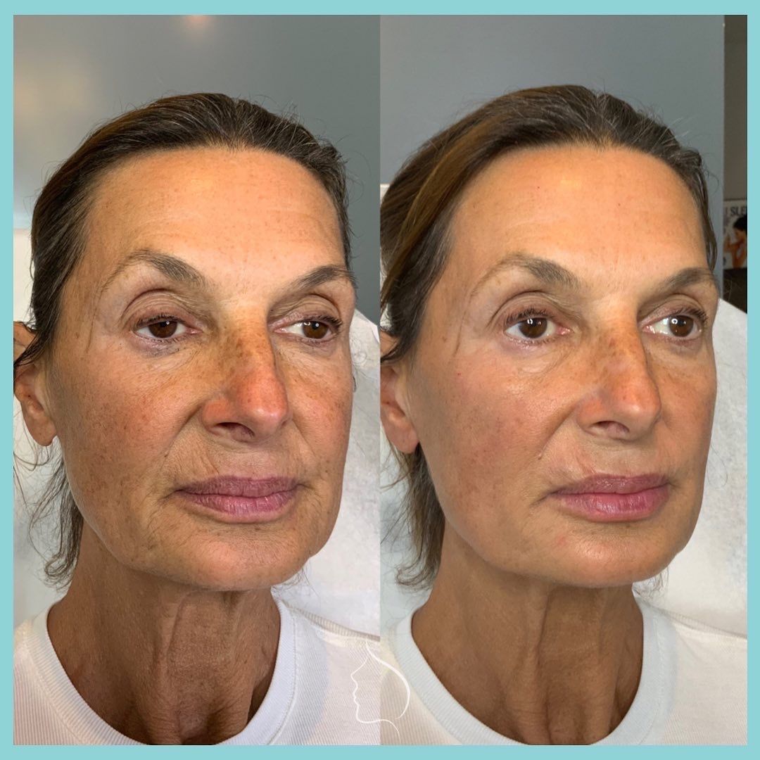 Before and after photos of a woman's face; reduced wrinkles and enhanced skin tone post-procedure.