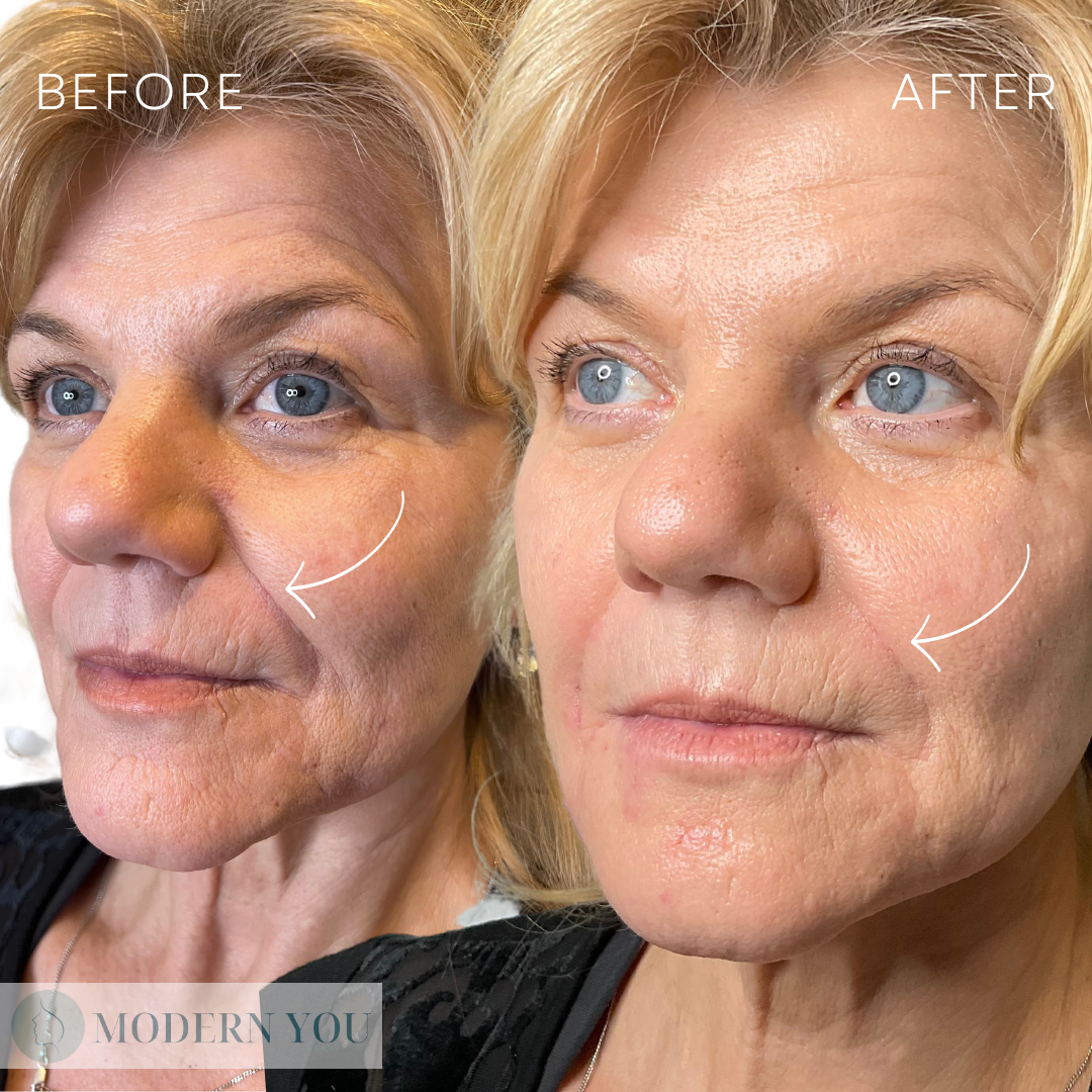 Before and after comparison of a woman's face. Shows a reduction of wrinkles and improved skin texture.