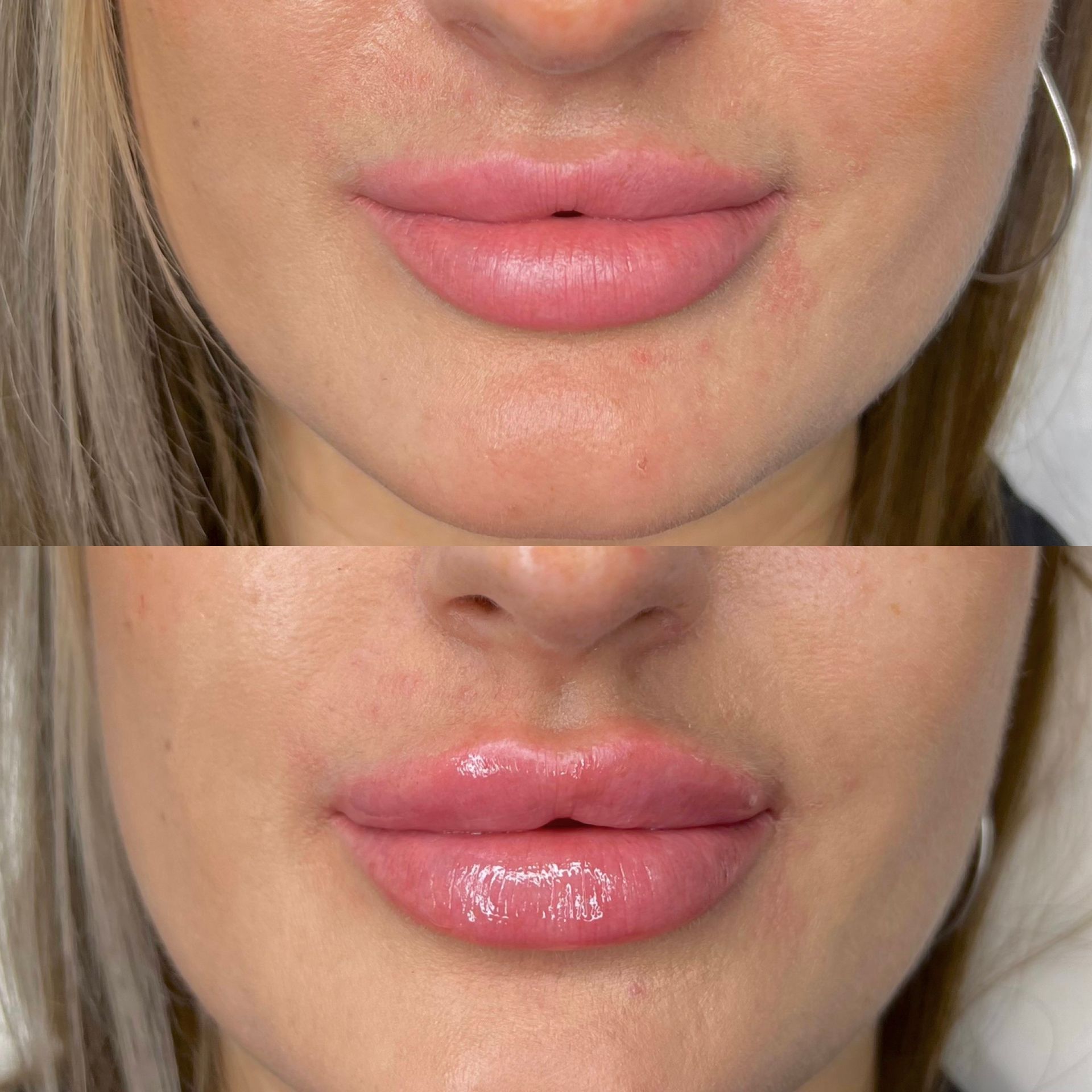 Before and after photos of a person's lips, showing lip augmentation with injectable filler. The 