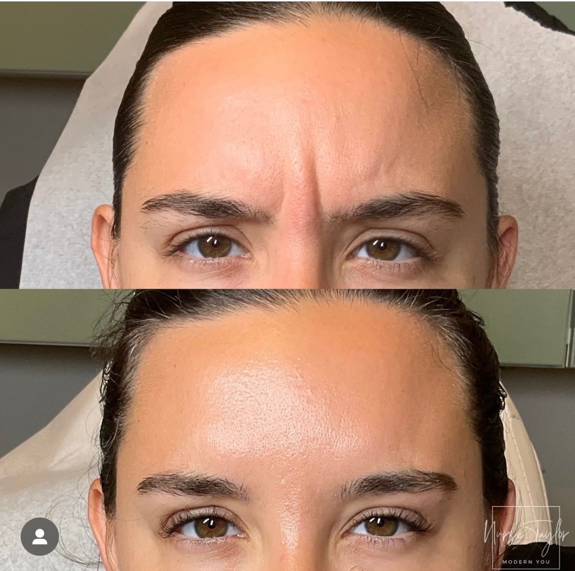 Top half: Woman with forehead wrinkles. Bottom half: Smooth forehead after treatment.