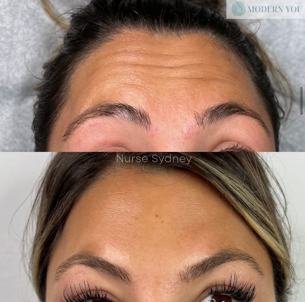 Before and after Botox: Wrinkled forehead transforms to smooth skin.