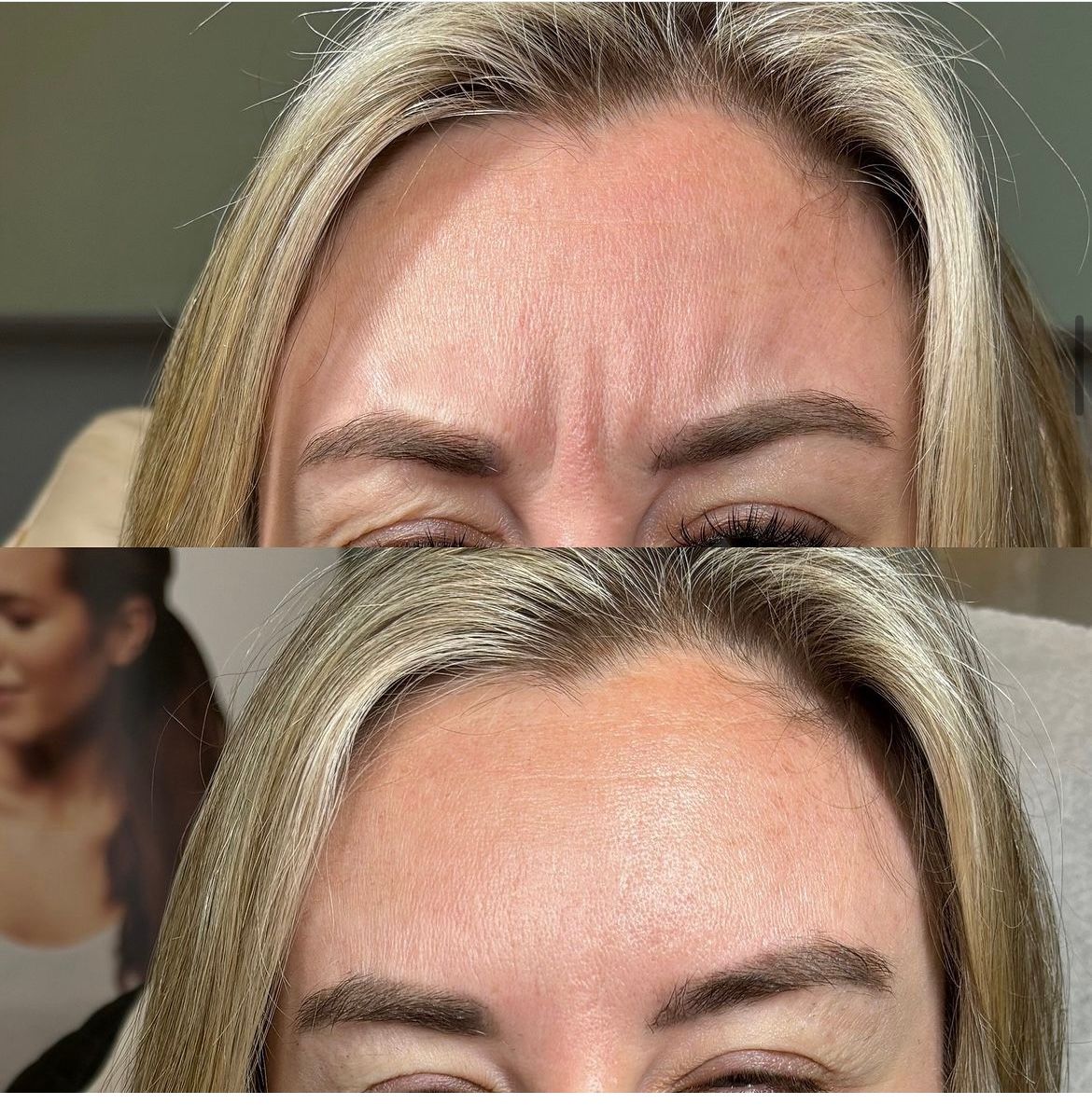 Before-and-after photo of a woman's forehead, showing a reduction in wrinkles after a cosmetic treatment.