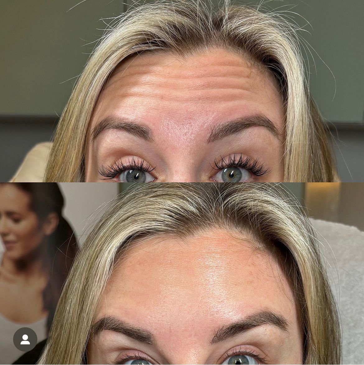 Top: Woman's forehead with wrinkles. Bottom: Same woman, smoother forehead after treatment.
