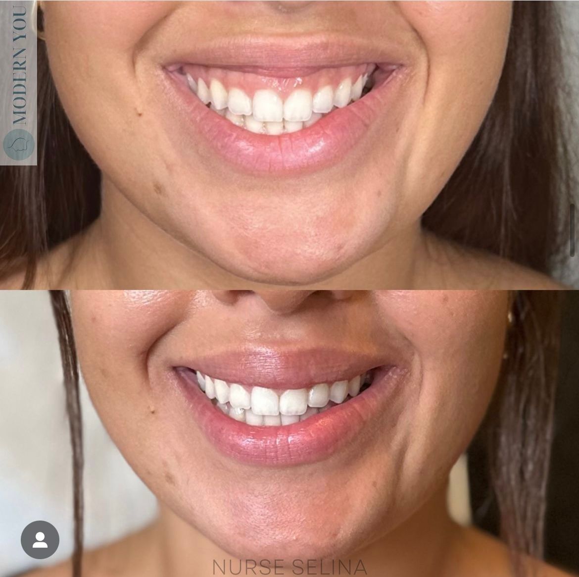 Side-by-side photos show a woman's smile before and after a cosmetic dental procedure, teeth appear whiter.