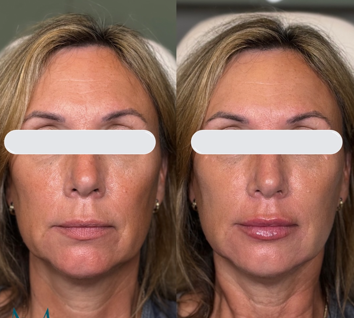 filler before and after burlington modern you medical aesthetics