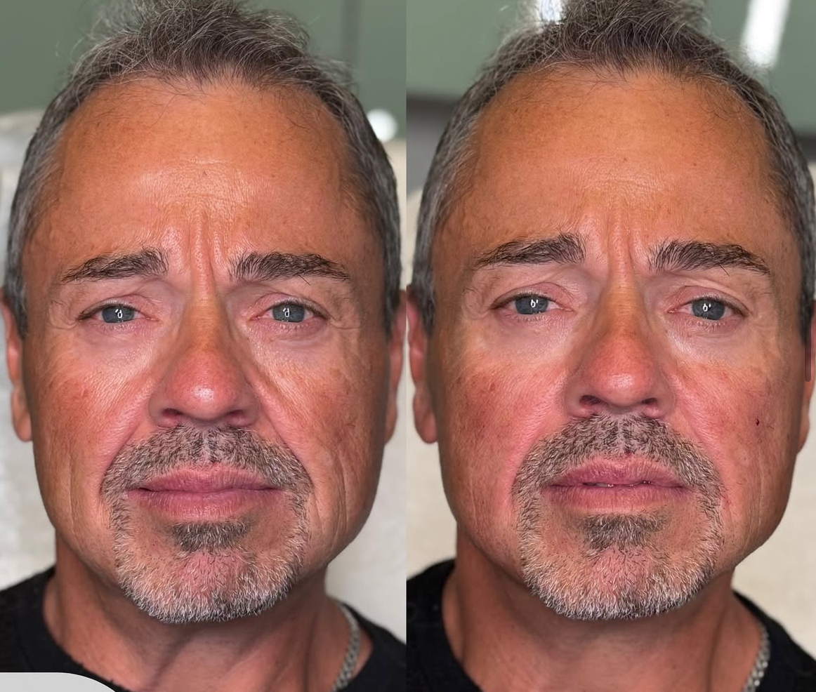 male filler before and after burlington modern you medical aesthetics