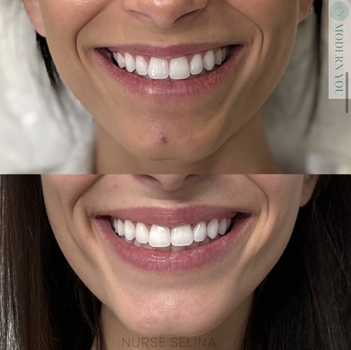 Side-by-side comparison of a woman's smile; top shows bright white teeth, bottom shows natural teeth with fuller lips.