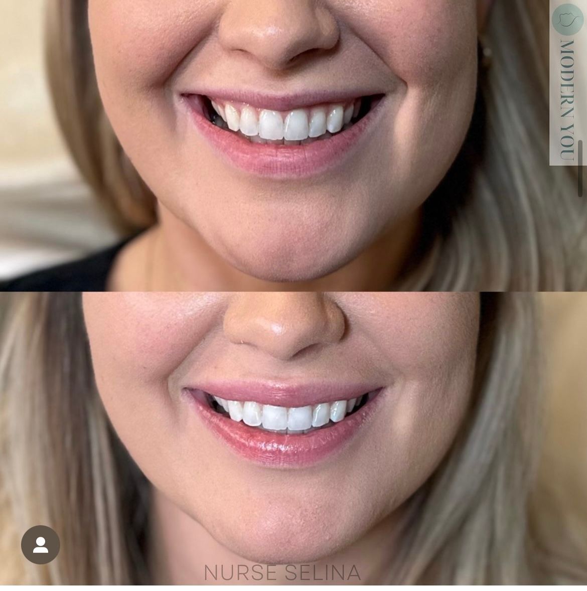 Before and after close-up photos of a woman's smile. The after photo has fuller lips.