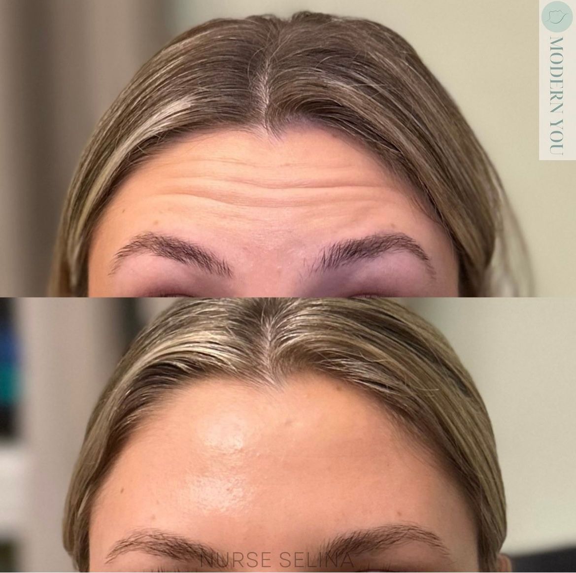 Top: Woman with forehead wrinkles. Bottom: Same woman, forehead smooth.