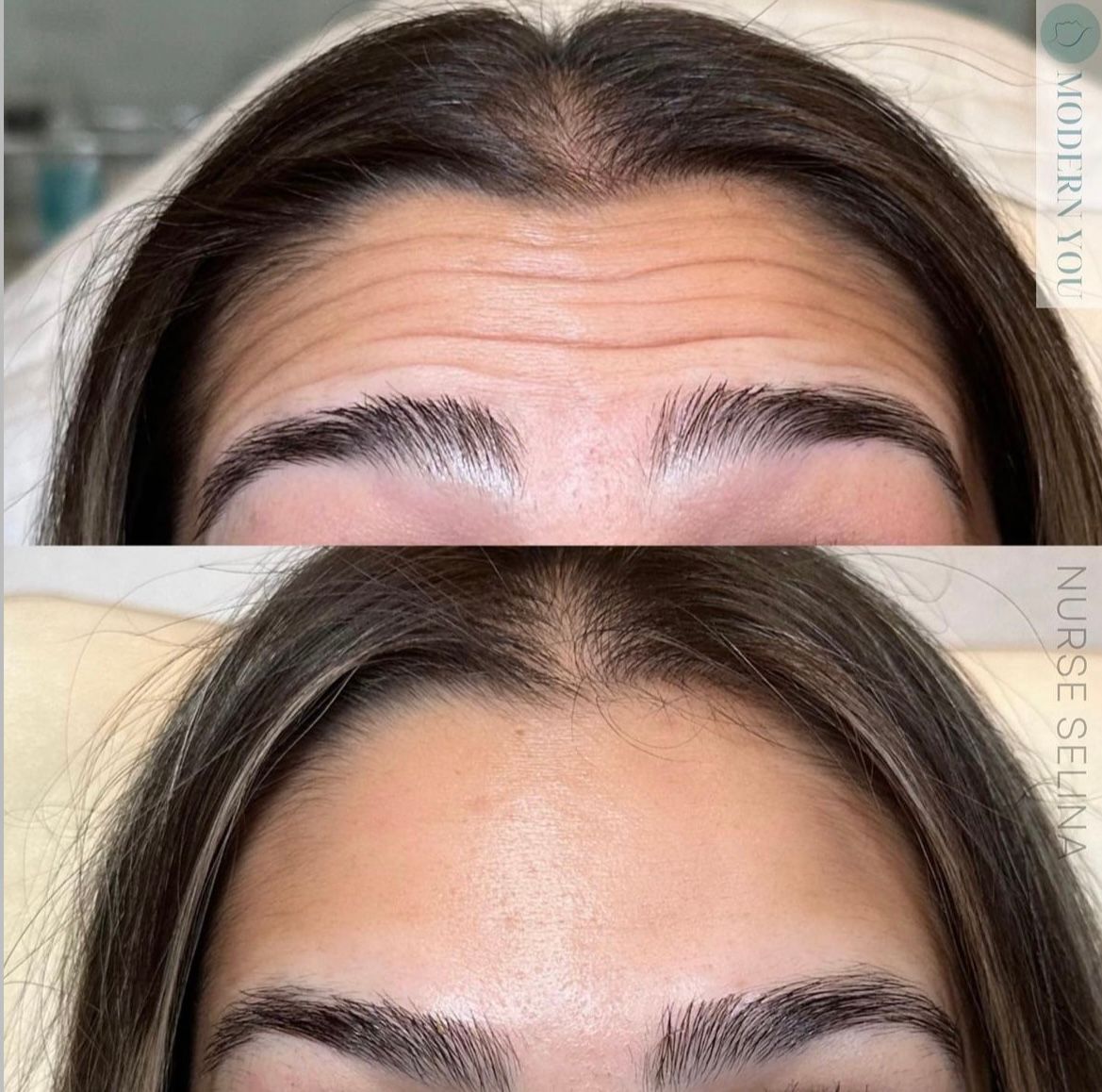 Comparison of a woman's forehead before and after wrinkle treatment. Top: wrinkled; bottom: smooth.