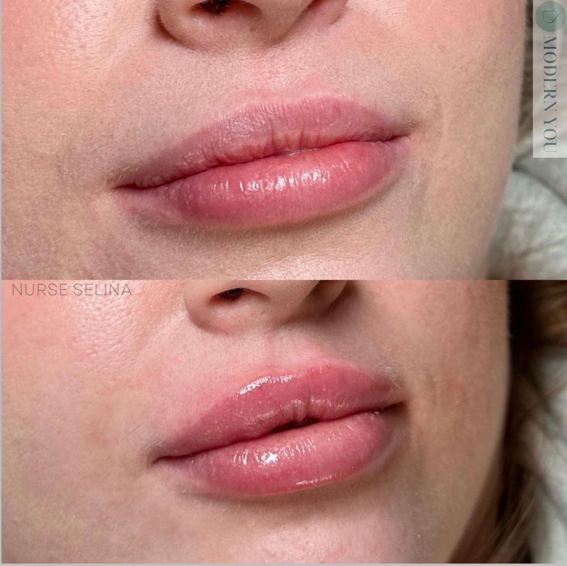 Lips before and after lip filler. Top, thinner lips; bottom, fuller, plumper lips. Both are glossy.