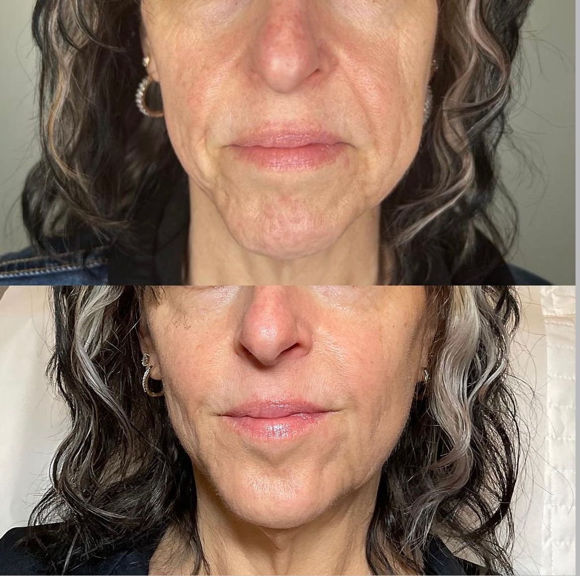 Before and after photos of a woman's face, showing reduction in wrinkles and smoother skin.