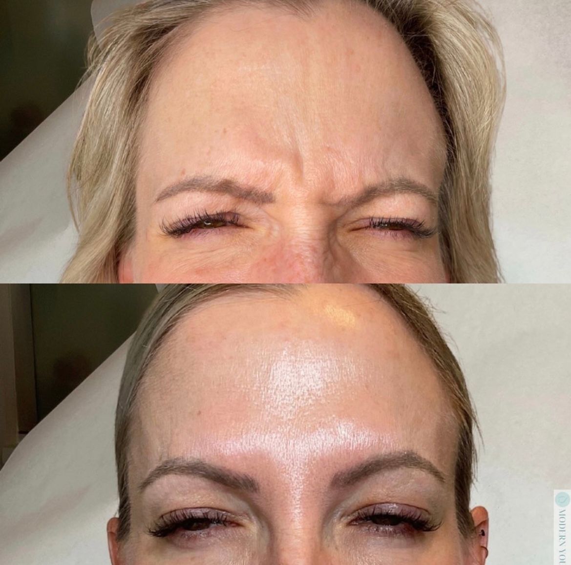 Before-and-after: woman's forehead, showing reduction of wrinkles after cosmetic treatment.