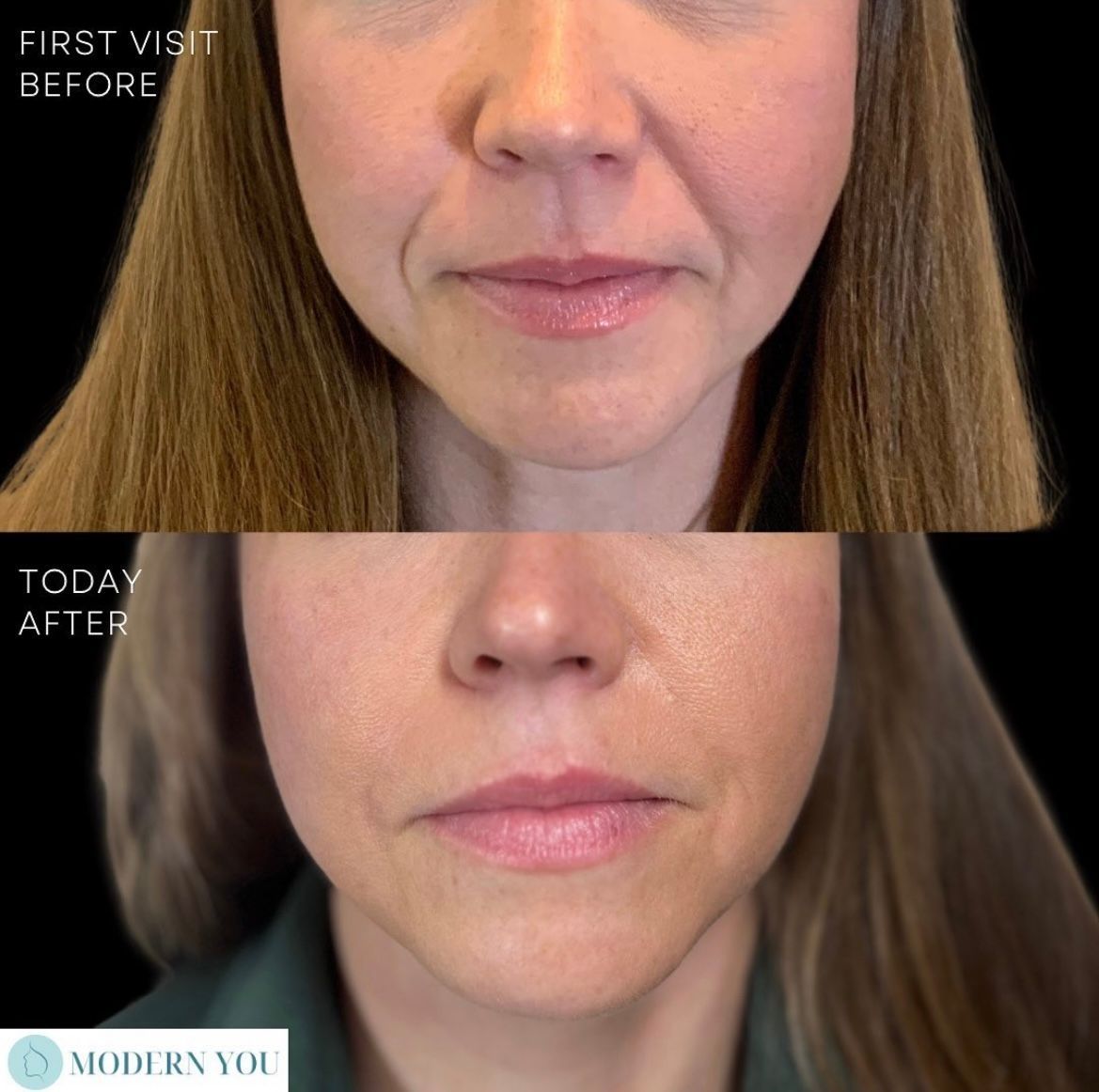 Side-by-side before and after photos of a woman's face show reduction of smile lines after cosmetic treatment.