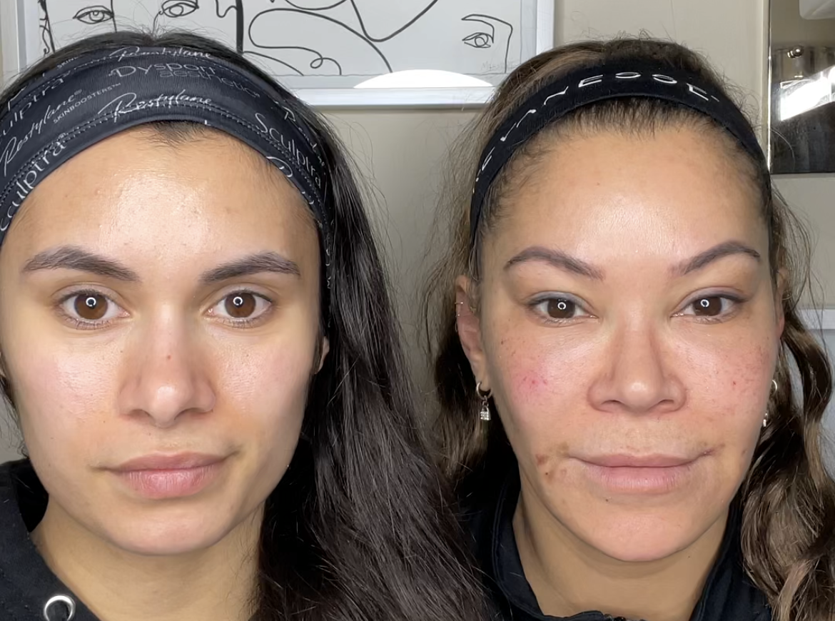 Two women side-by-side. The woman on the right has some redness and her face looks more round than the other.