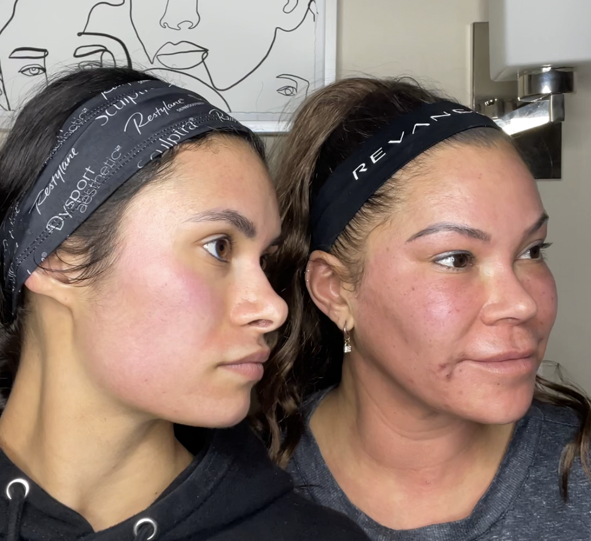 Side-by-side photos: Younger woman's face and older woman's face after a facial treatment. Both wear headbands.