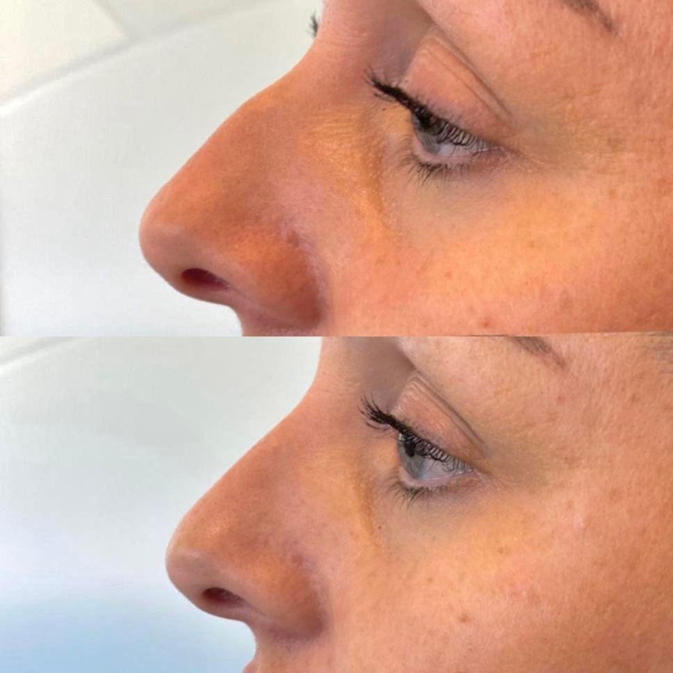 Before and after profile view of a nose; after appears straighter and less prominent.