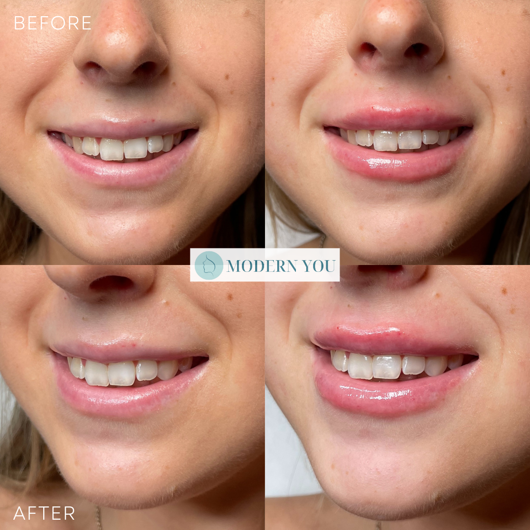 Before/After photos of a woman's lips.  Increased lip fullness after cosmetic injections.