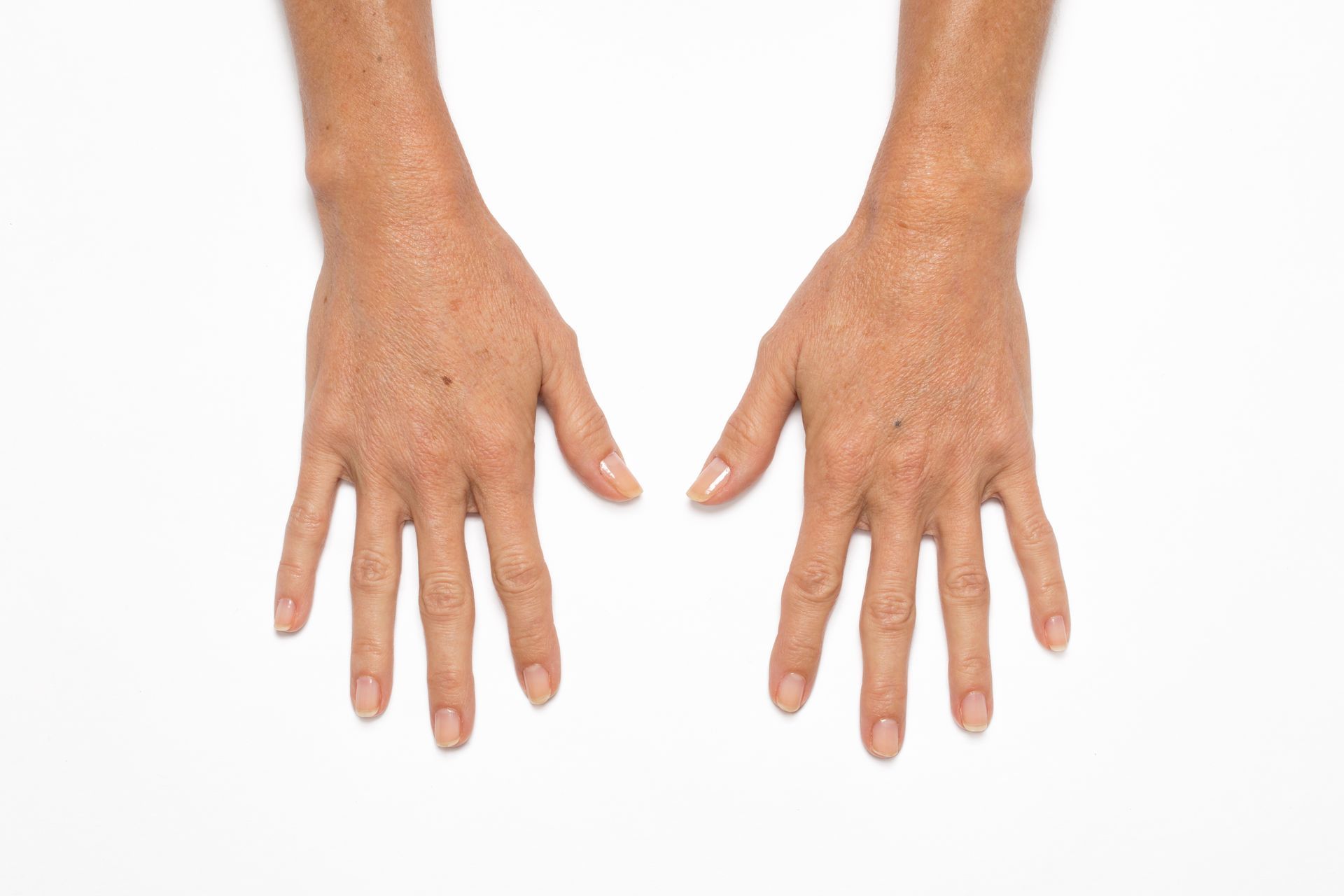 Two hands, palms down, against a white background. Skin tone with age spots, fingers extended.