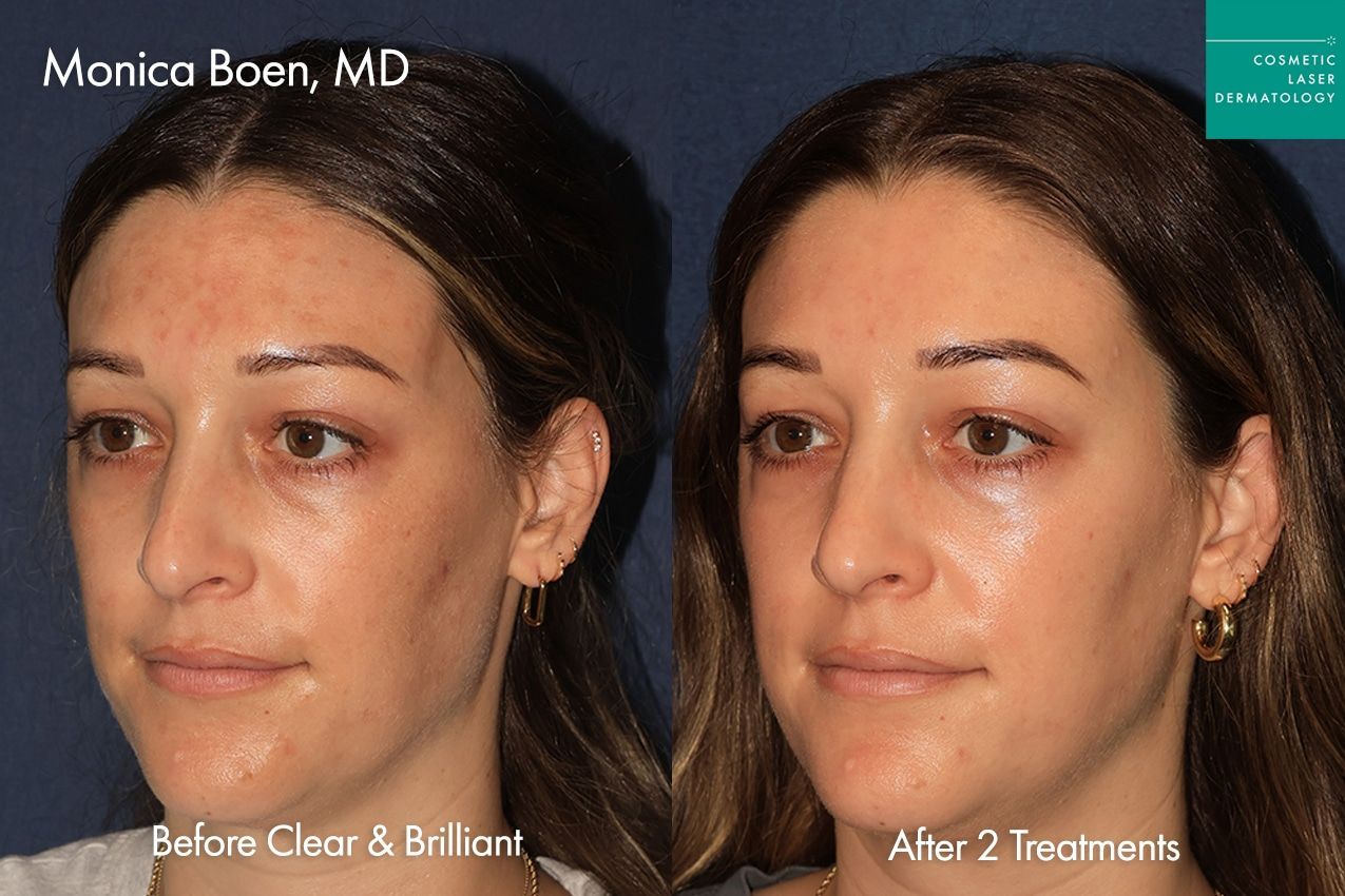 Before-and-after side-by-side face photo showing skin improvement after 2 treatments