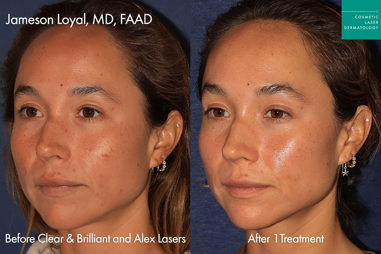 Side-by-side facial skin before-and-after photos showing reduced blemishes and smoother skin texture.