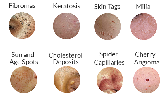 Skin conditions: fibromas, keratosis, skin tags, milia, sun/age spots, cholesterol deposits, spider capillaries, cherry angioma.