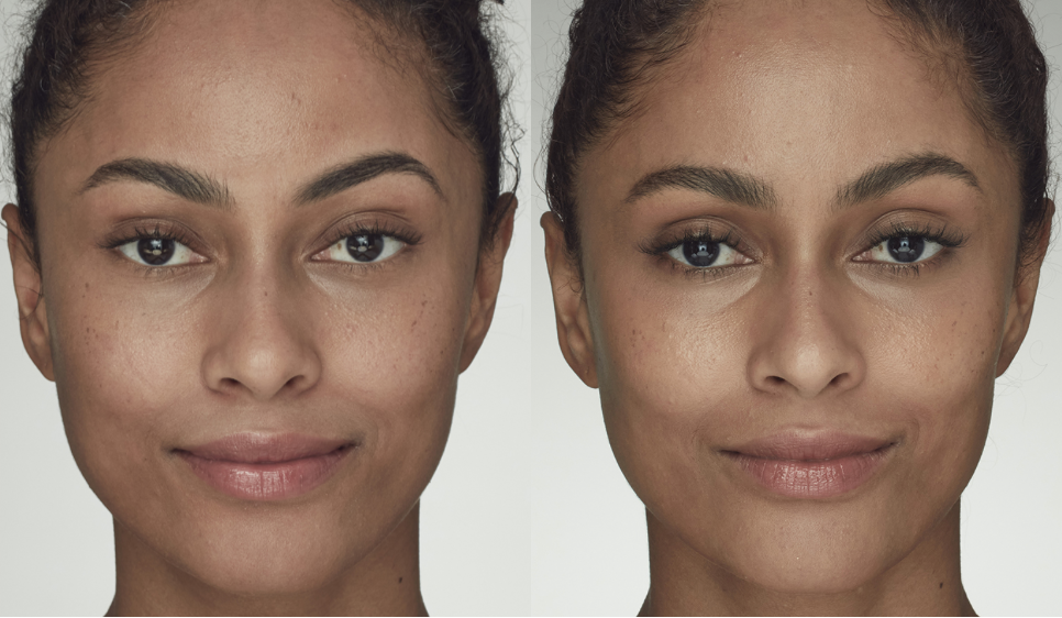 Before and after facial comparison of a woman with improved skin tone, cheek contour and eyebrow shape.