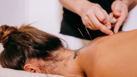 A patient receiving Acupuncture Treatment