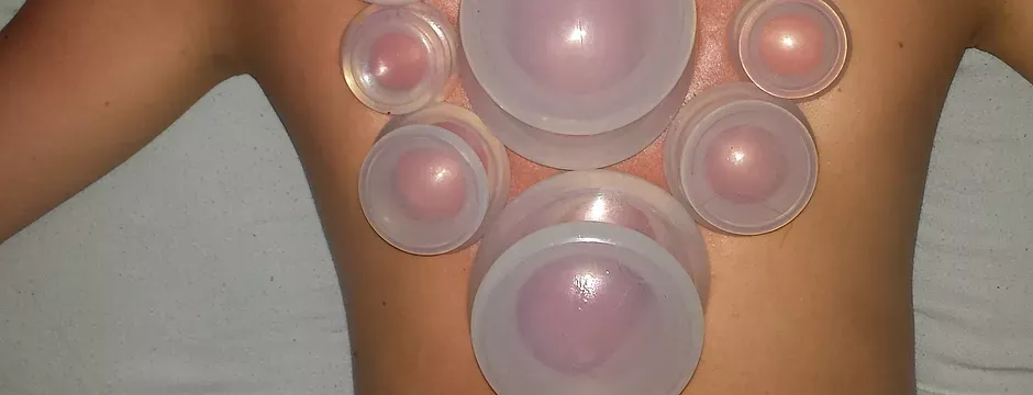 Benefits of Cupping Therapy Benefits of Cupping Therapy