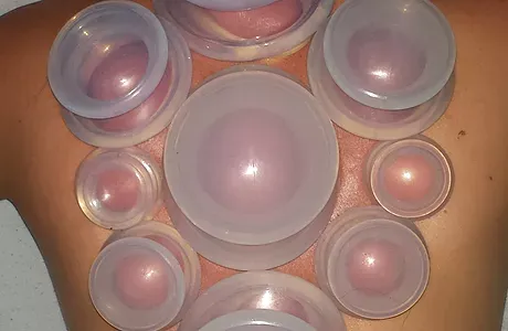 Cupping Massage Therapy Cupping Massage Therapy