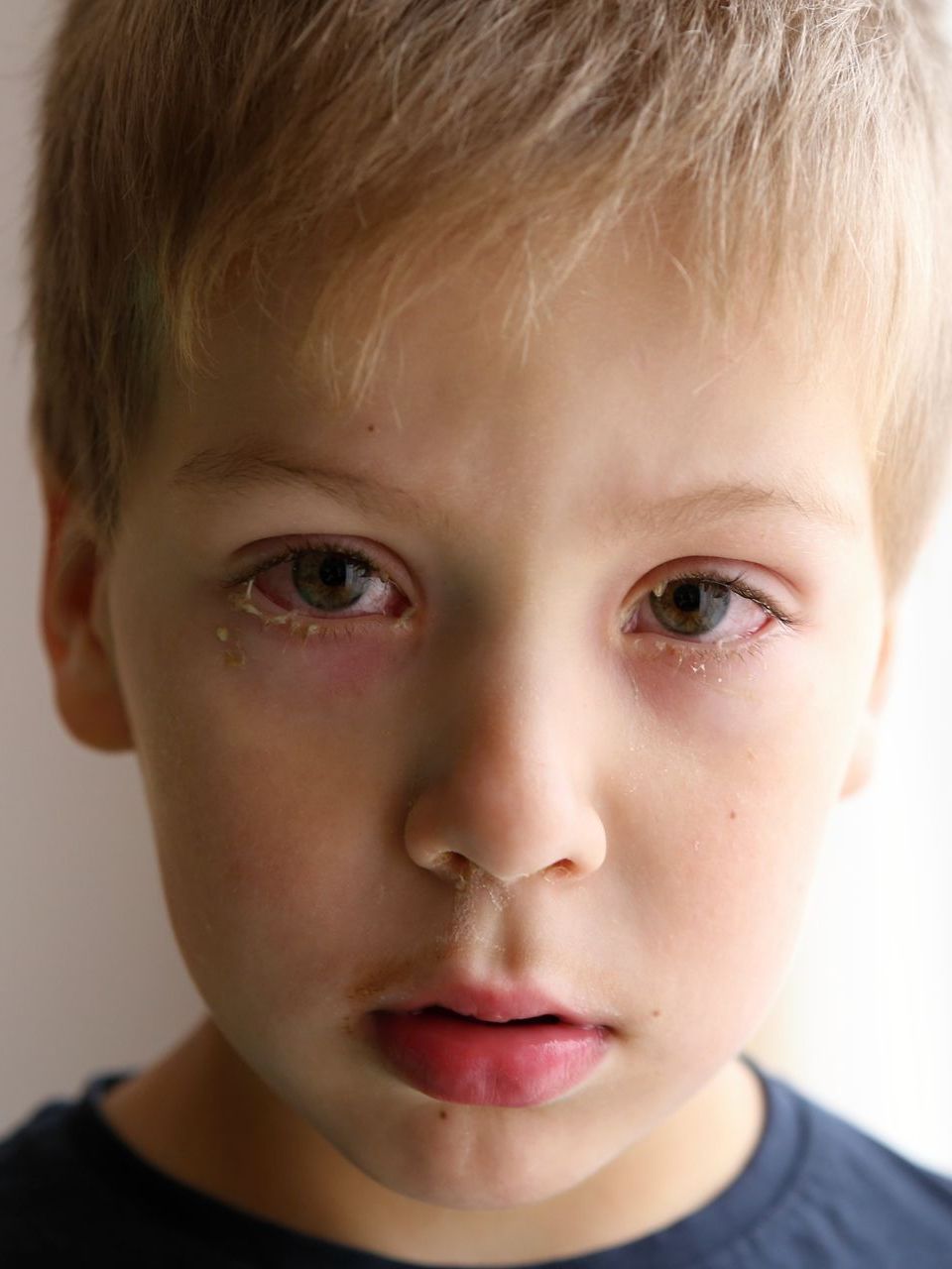 A child with red, irritated eyes and visible tearing, appearing distressed.