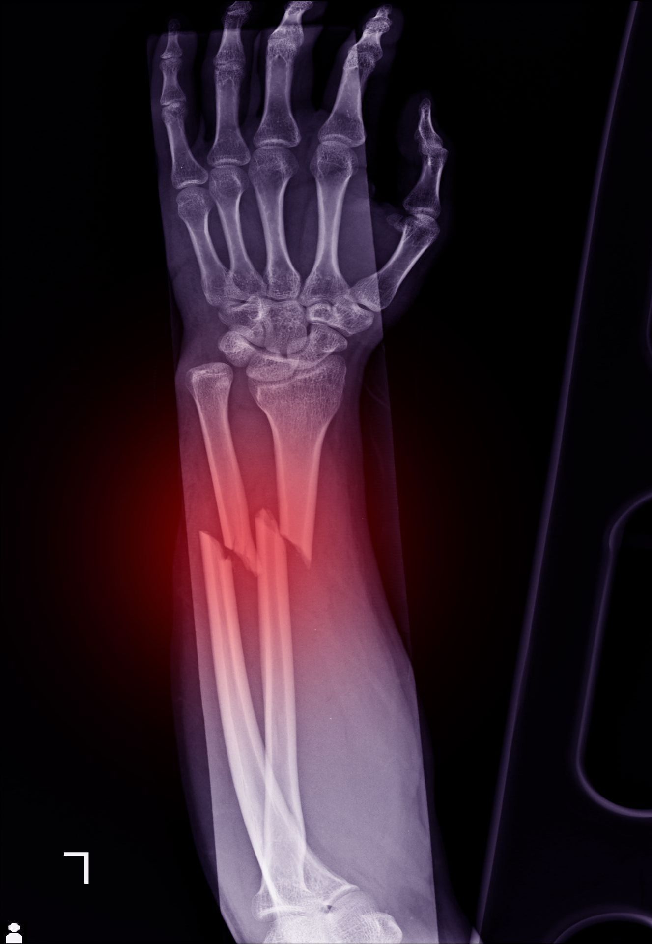 X-ray showing a complex fracture of both the radius and ulna bones in a forearm, with highlighted red areas at the breaks.