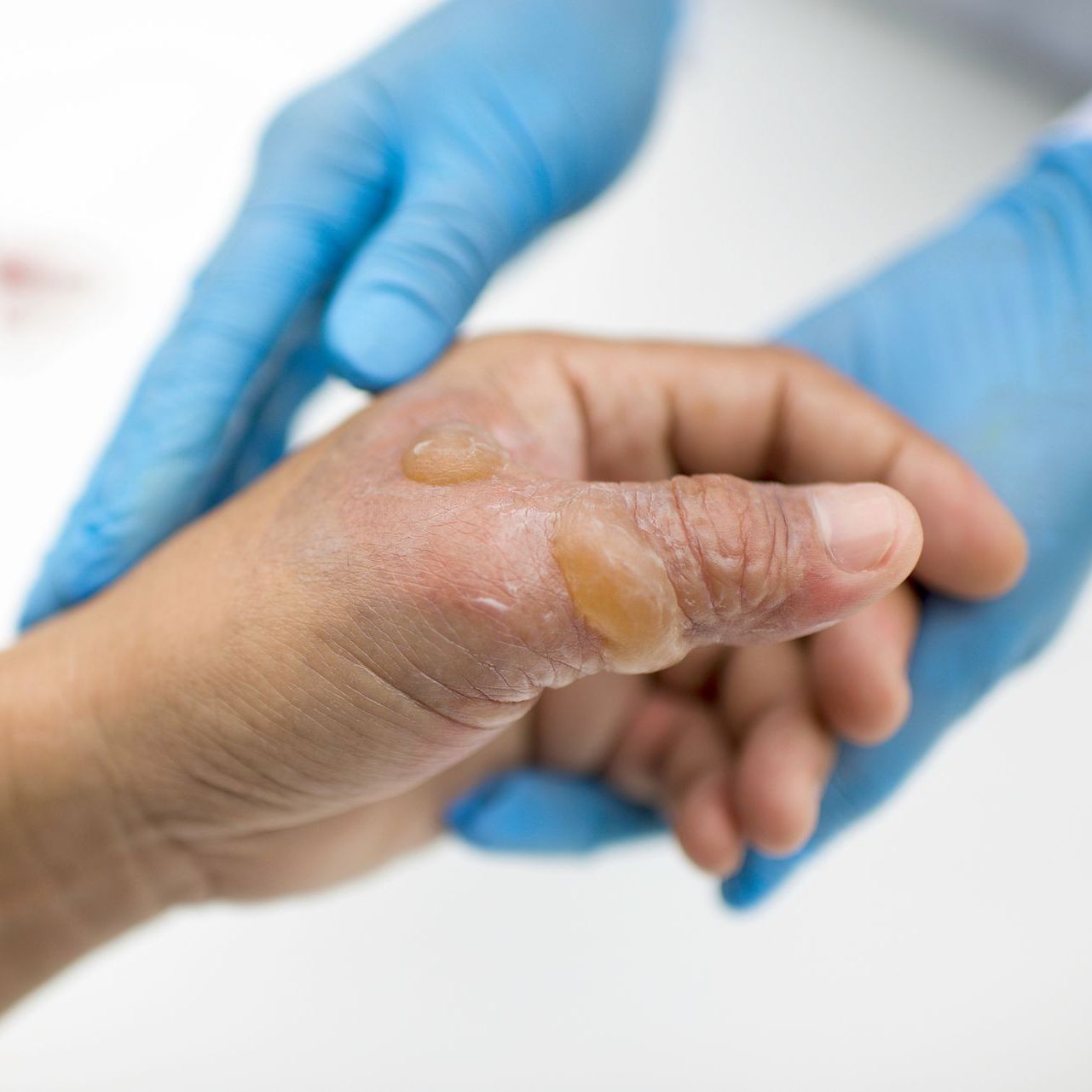 A gloved hand holds another hand showing two yellow-tinted blisters on the skin near the base of the thumb.