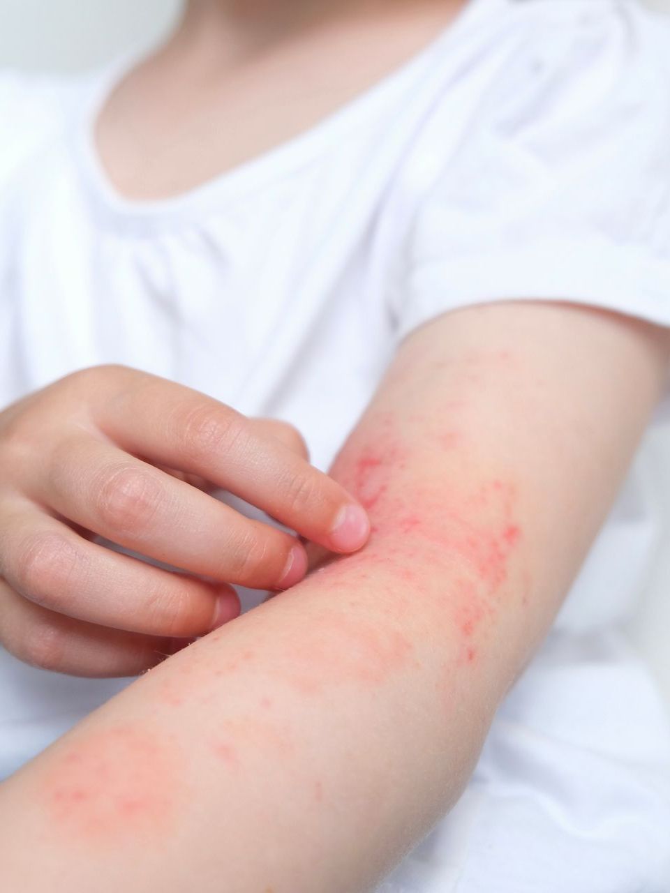 Close-up of an arm with a red, irritated skin rash in the inner elbow, touched by a hand.