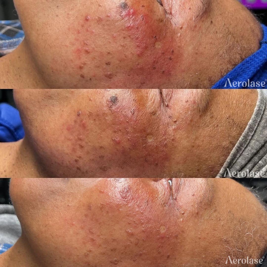 Redness, acne and skin tags before and after Aerolase Neo Elite treatment
