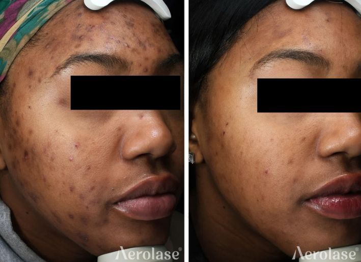 Acne and post inflammatory hyperpigmentation before and after Aerolase Neo Elite treatment
