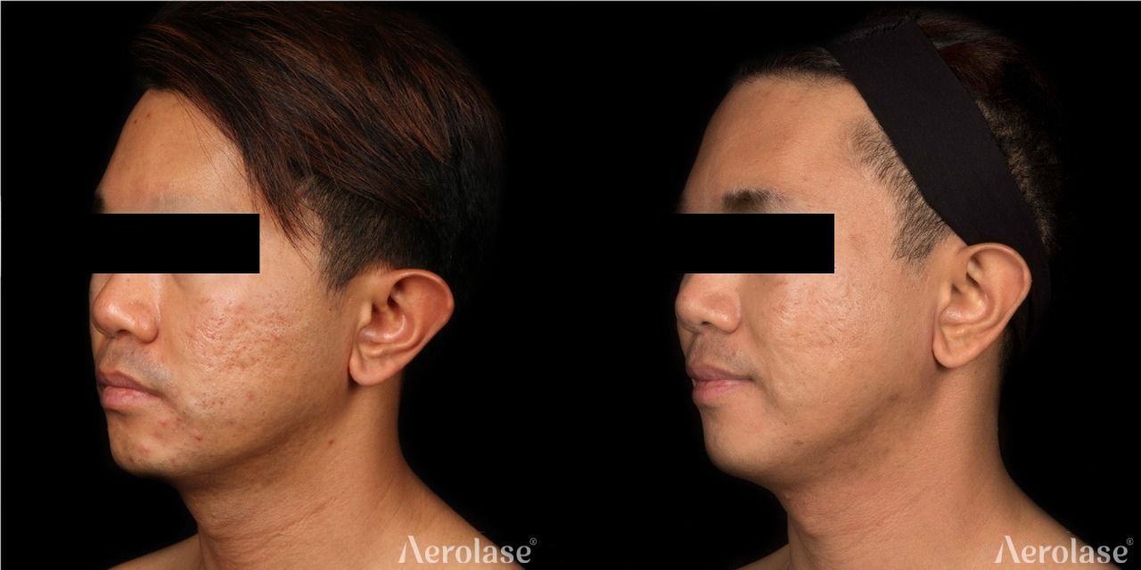 Acne scars on the face before and after Aerolase Neo Elite treatment
