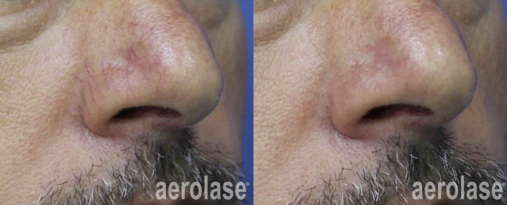 Facial veins before and after Aerolase Neo Elite treatment