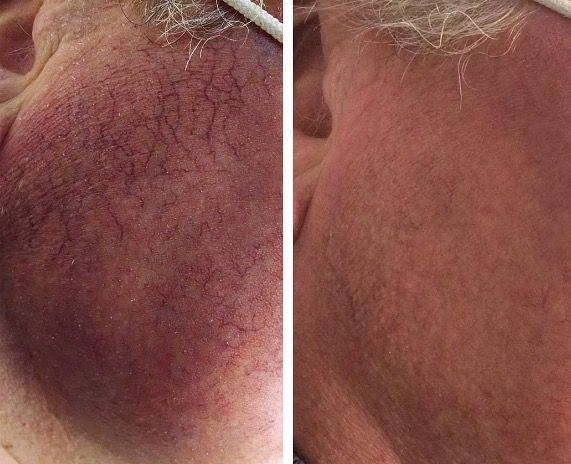 Facial veins before and after Aerolase Neo Elite treatment