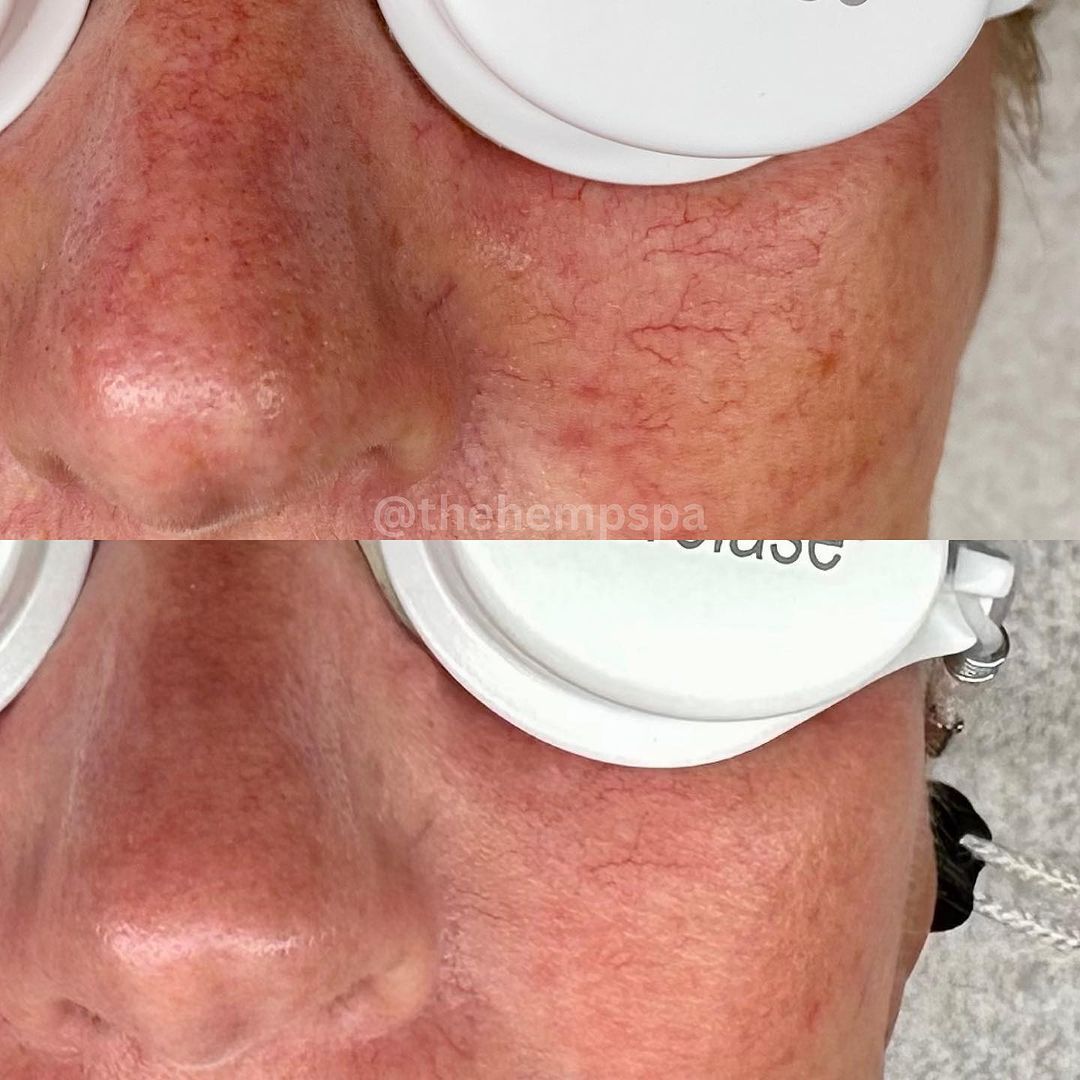 Veins before and after Aerolase Neo Elite treatment