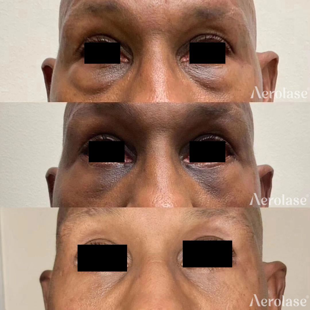 Pigmentation and rejuvenation after lower eyelid surgery before and after Aerolase Neo Elite treatment